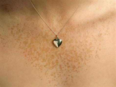 Breast cancer symptoms: What chest freckles can mean